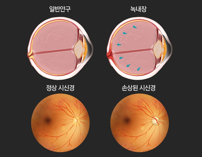 녹내장