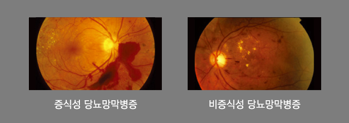 증식성 당뇨병성망막증 비증식성 당뇨병성망막증